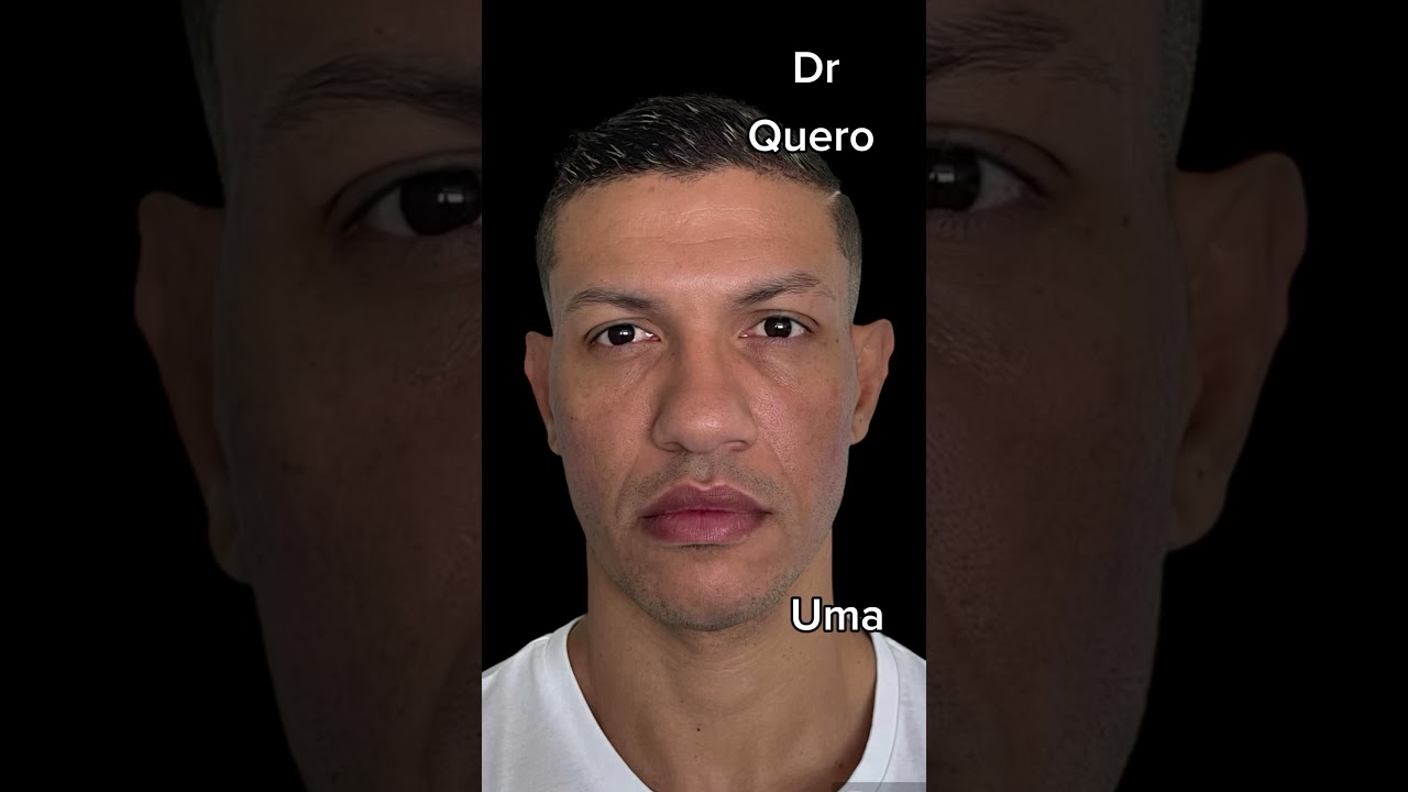Sensacional transformação de Harmonização Facial pelo Dr. Gabriell Fernandes.