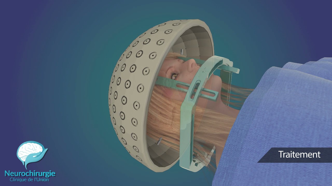 Pathologies traitées par radiochirurgie Gamma Knife  - clinique de l'union Toulouse