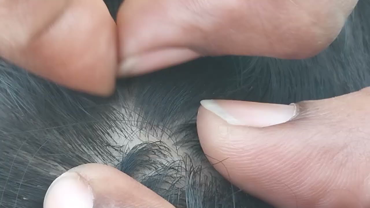 Nitpicking ASMR video 189 #kuto   zoom-in video  popping sound ( few noises in background )