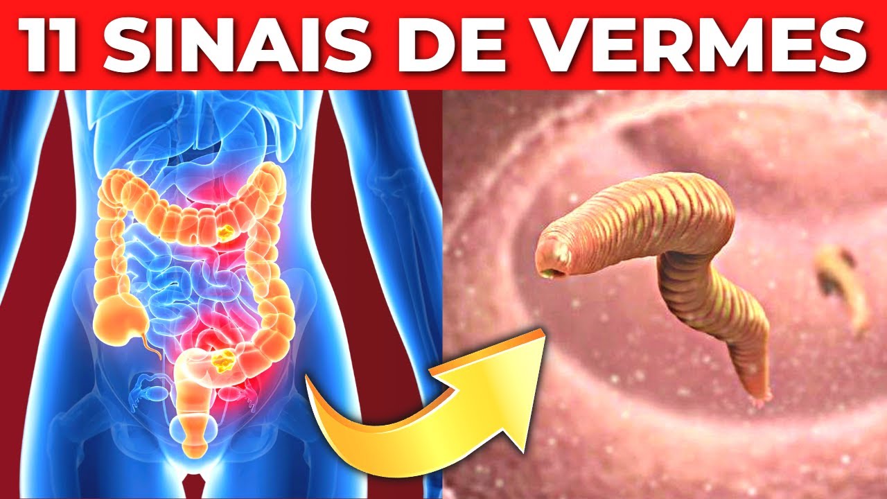 11 SINAIS DE VERMES QUE VOC&Ecirc; DEVE SE PREOCUPAR | VOC&Ecirc; TEM VERMINOSE?
