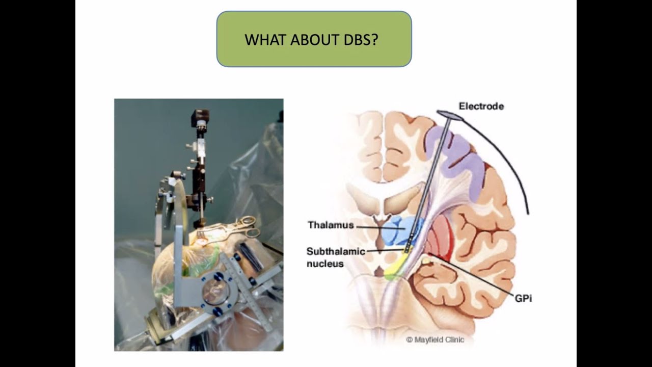 May 2021 Branch Meeting with Dr Philip Buttery - Deep Brain Stimulation