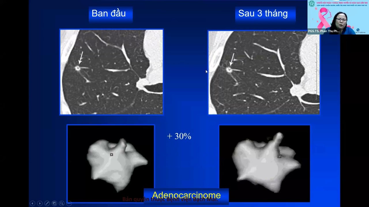 7. Tiếp cận chẩn đoán nốt mờ phổi