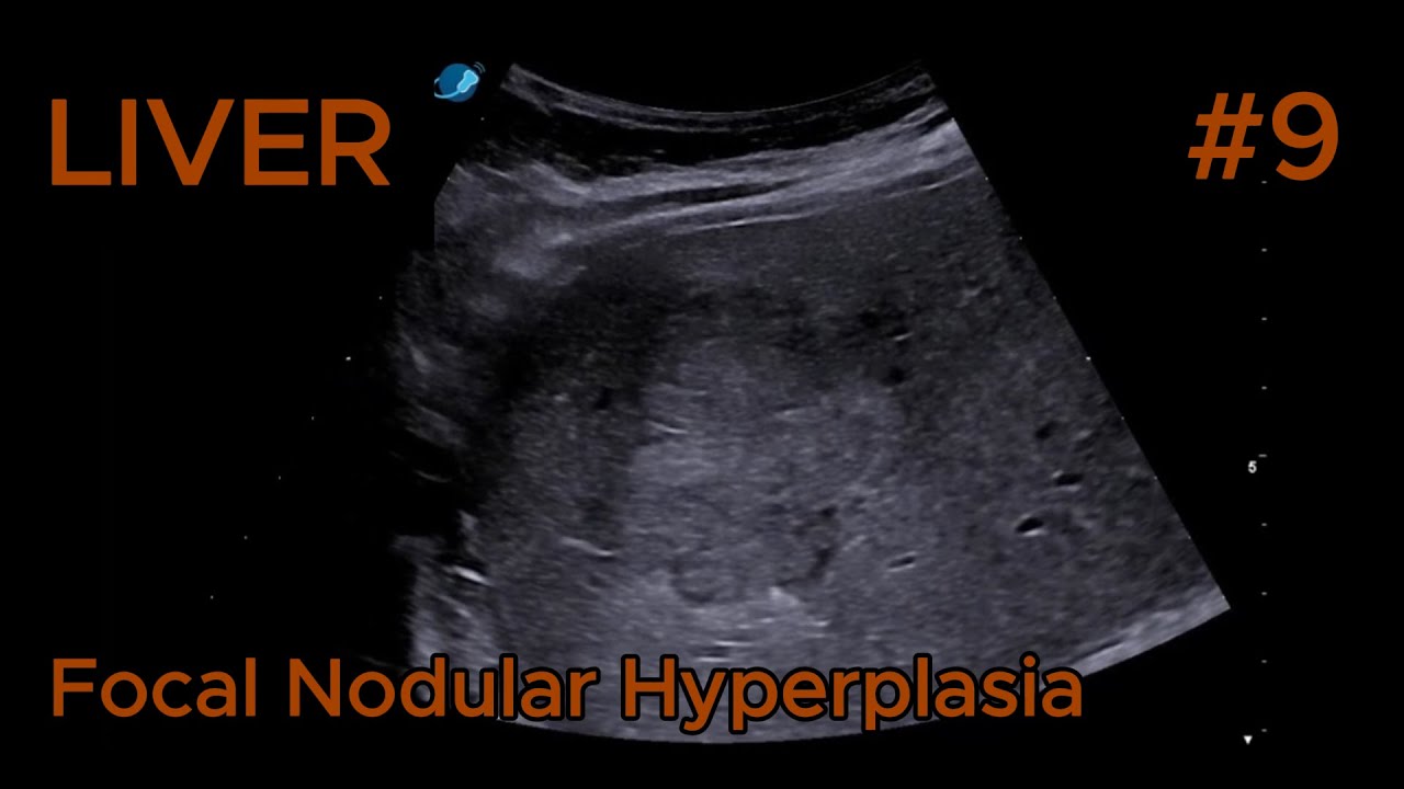 Liver &ndash; Focal Nodular Hyperplasia &ndash; Isoechoic &ndash; Clip 2 B-mode + Color + microV