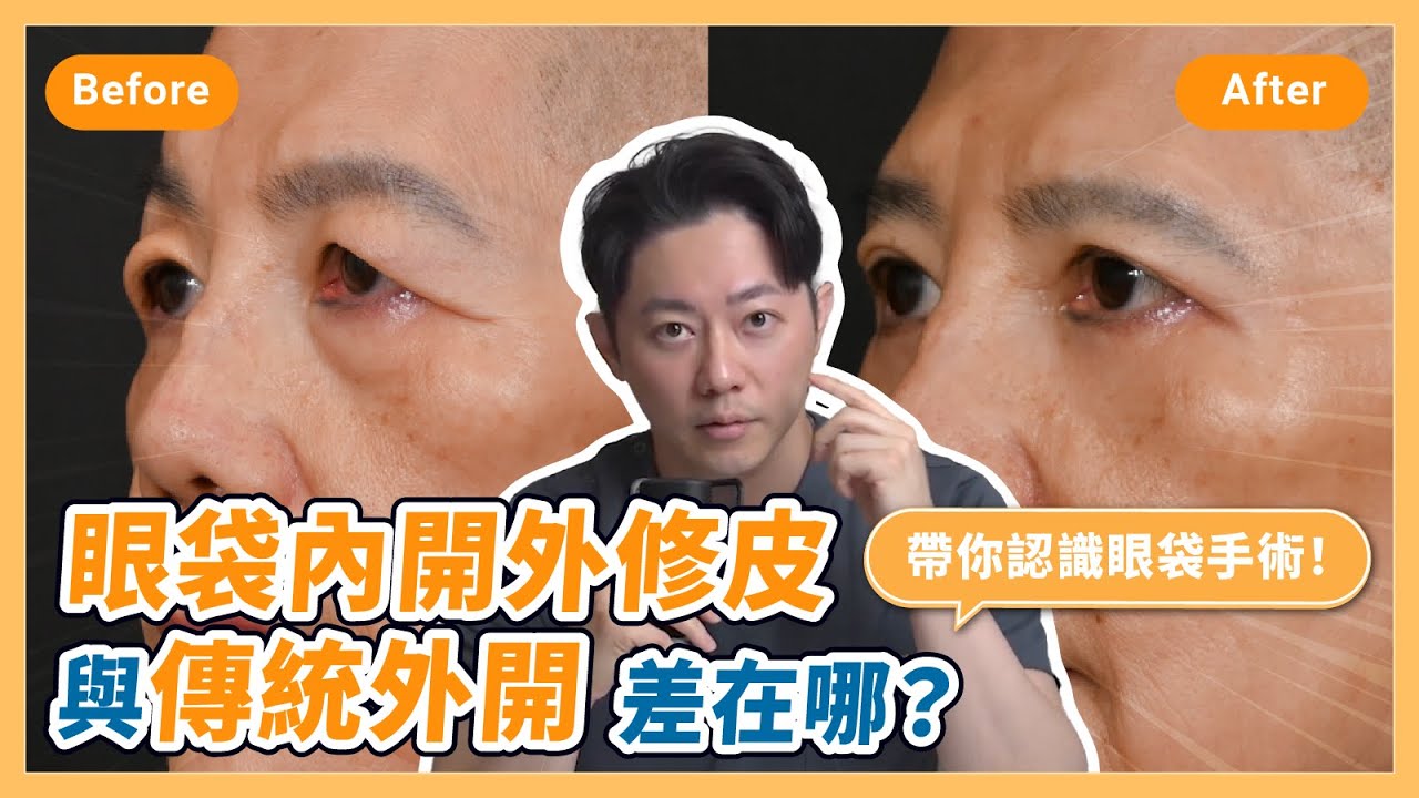 眼袋內開外修皮與傳統外開差別｜帶你認識眼袋手術！