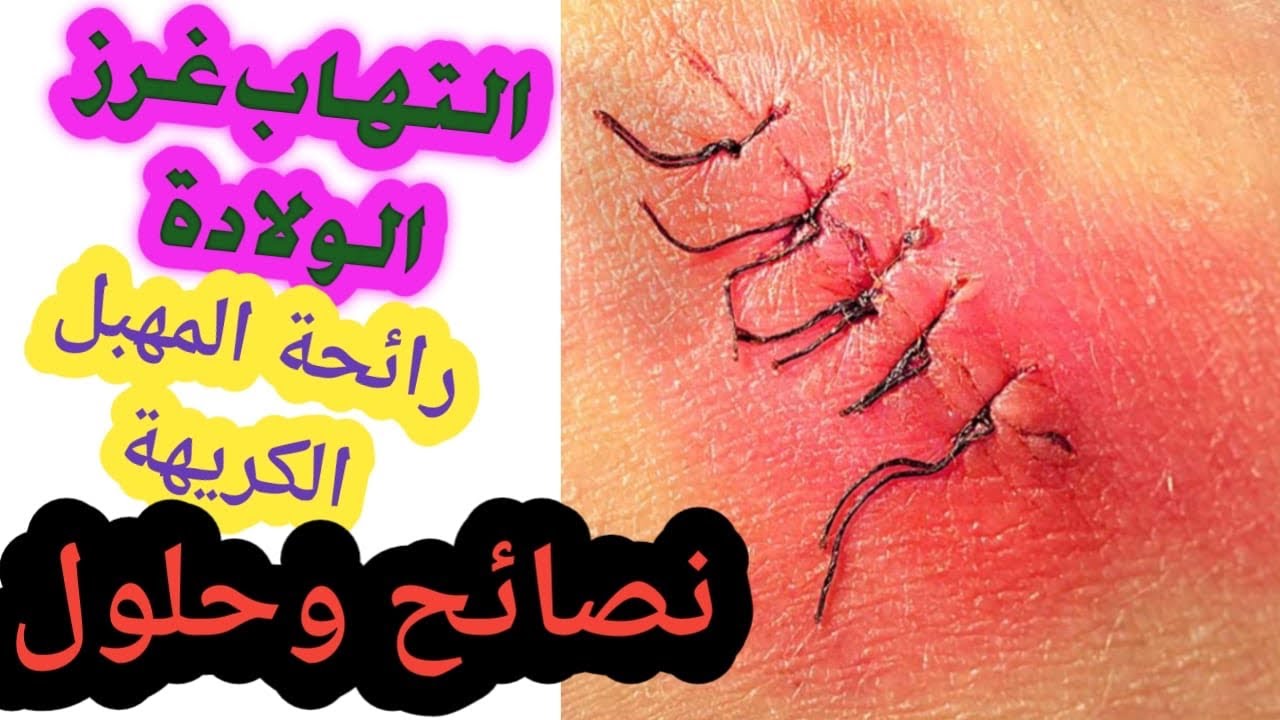 أسباب التهاب وتورم جرح الولادة الطبيعية 🩸تعفن الغرز+متى يمكن ان يحدت هذا الالتهاب