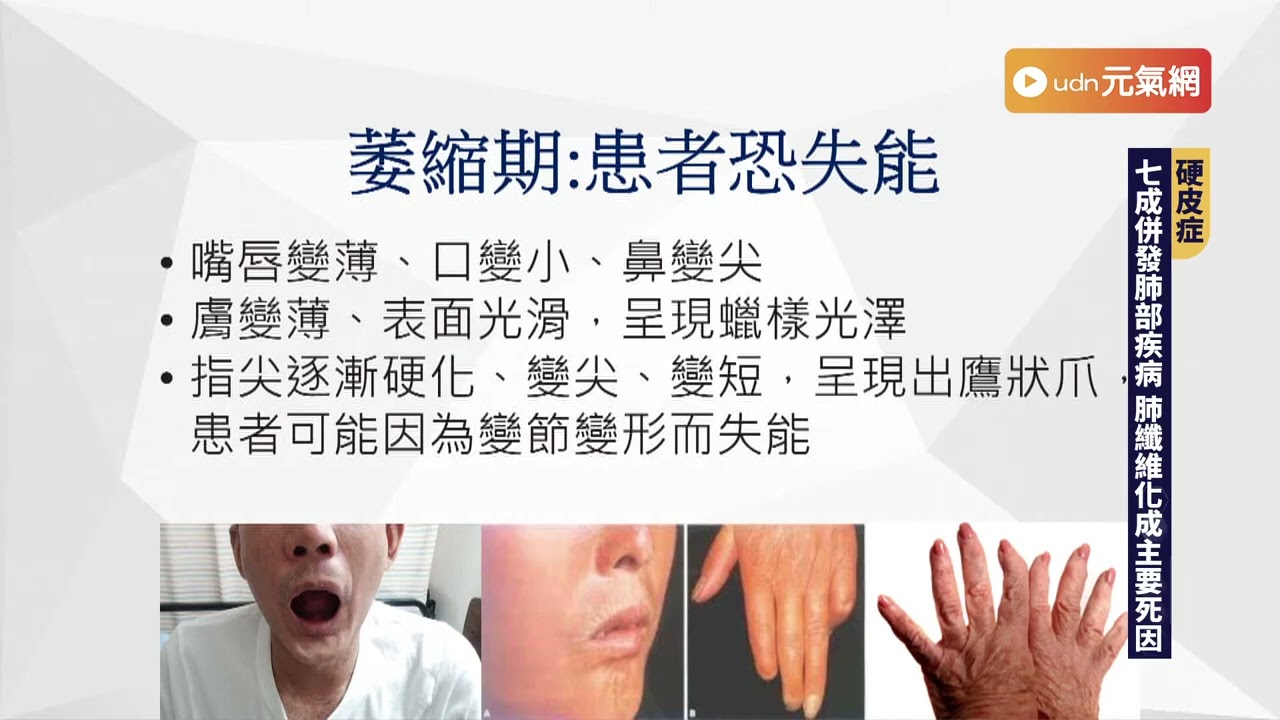 【專家論壇－肺纖維化】硬皮症｜7成併發肺部疾病 肺纖維化已為主要死因