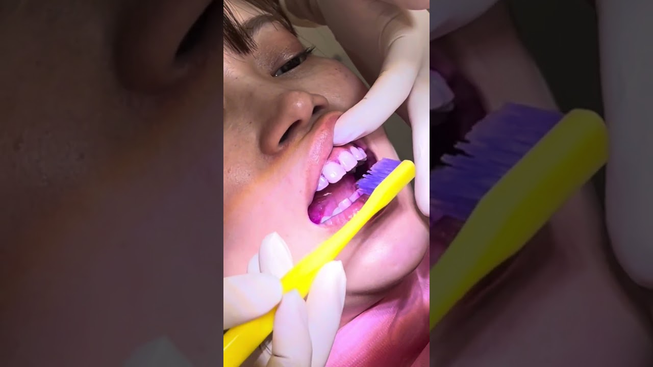 抜き打ち‼️磨き残しチェック🦷🦠