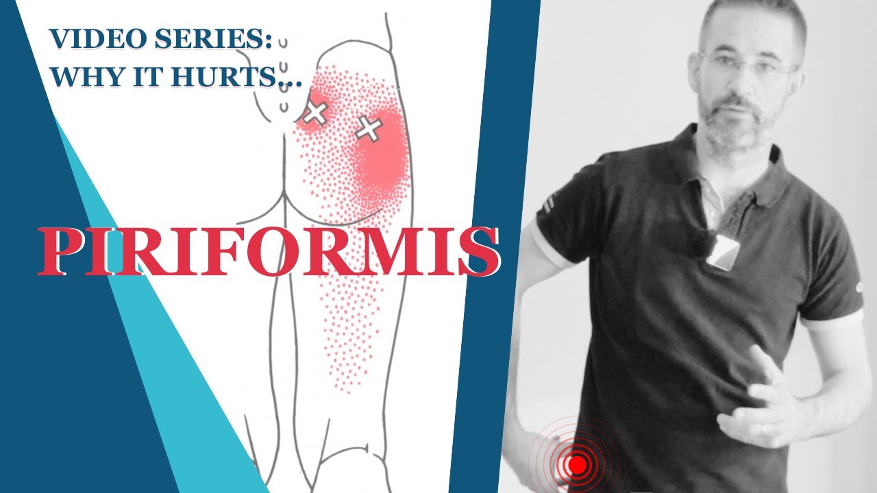 Piriformis Syndrome: Why Posture Matters | Fixing Buttock Pain, Low Back Pain & Sciatica