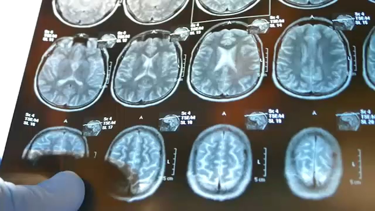 New brain tumor drug hits market 16 years after Duke neurosurgeon's discovery: ' Excited'