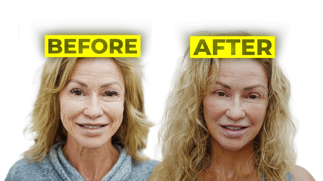 I Got a Facelift and Here's What Happened