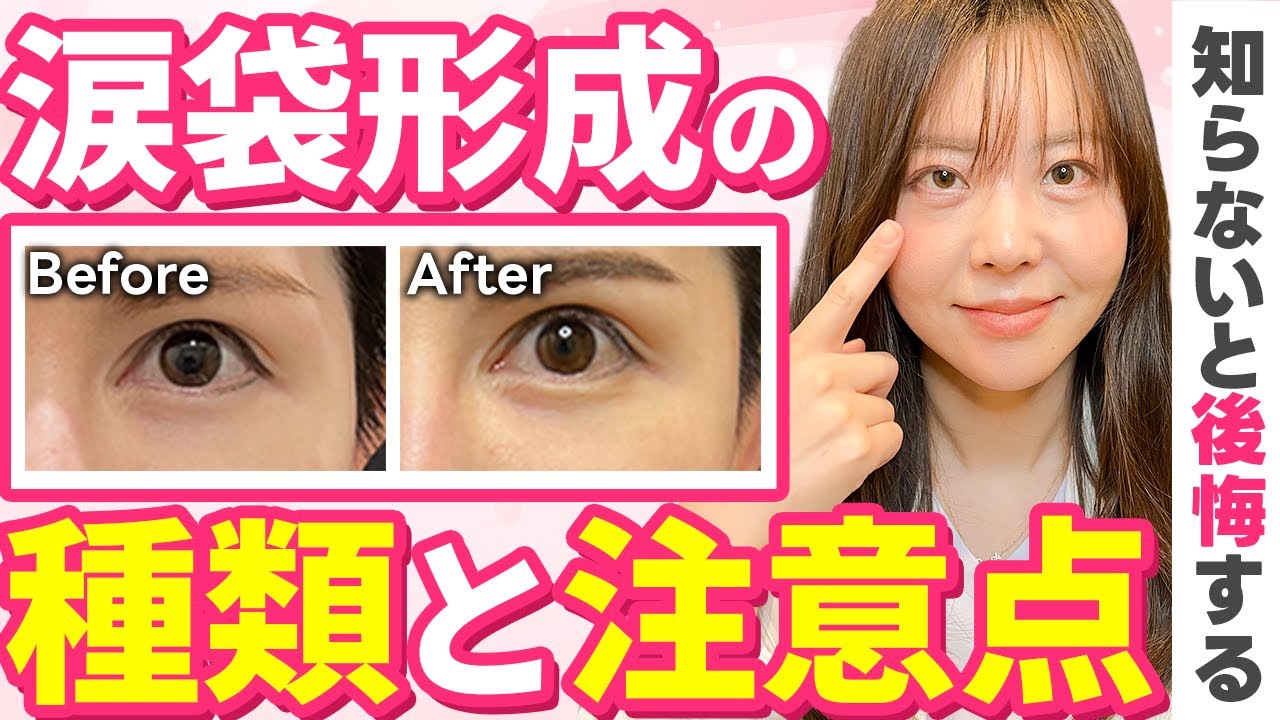 【涙袋形成】施術の種類と注意すべきこと・失敗しないためのポイントを徹底解説します！