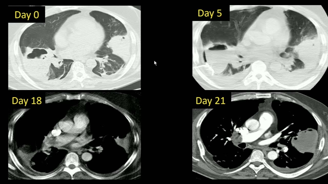 Acute Pulmonary Embolism