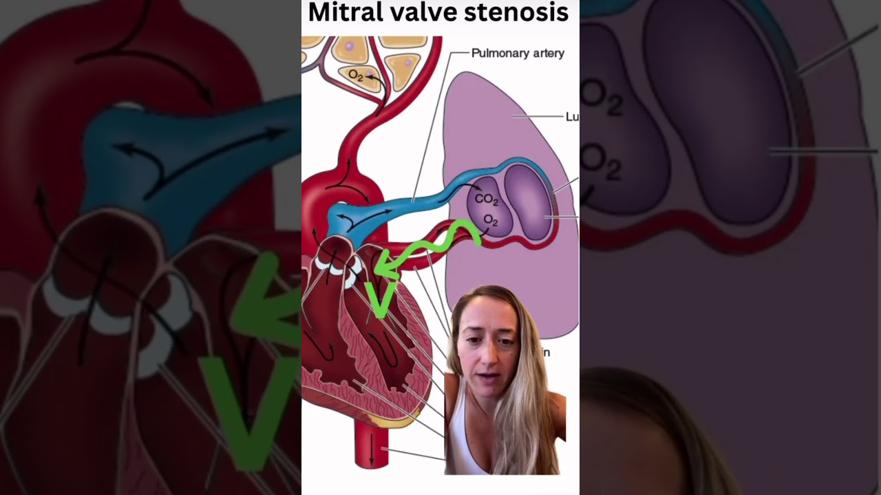 Mitral valve stenosis in pregnancy #obgyn #obstetrics #heart #cardiac