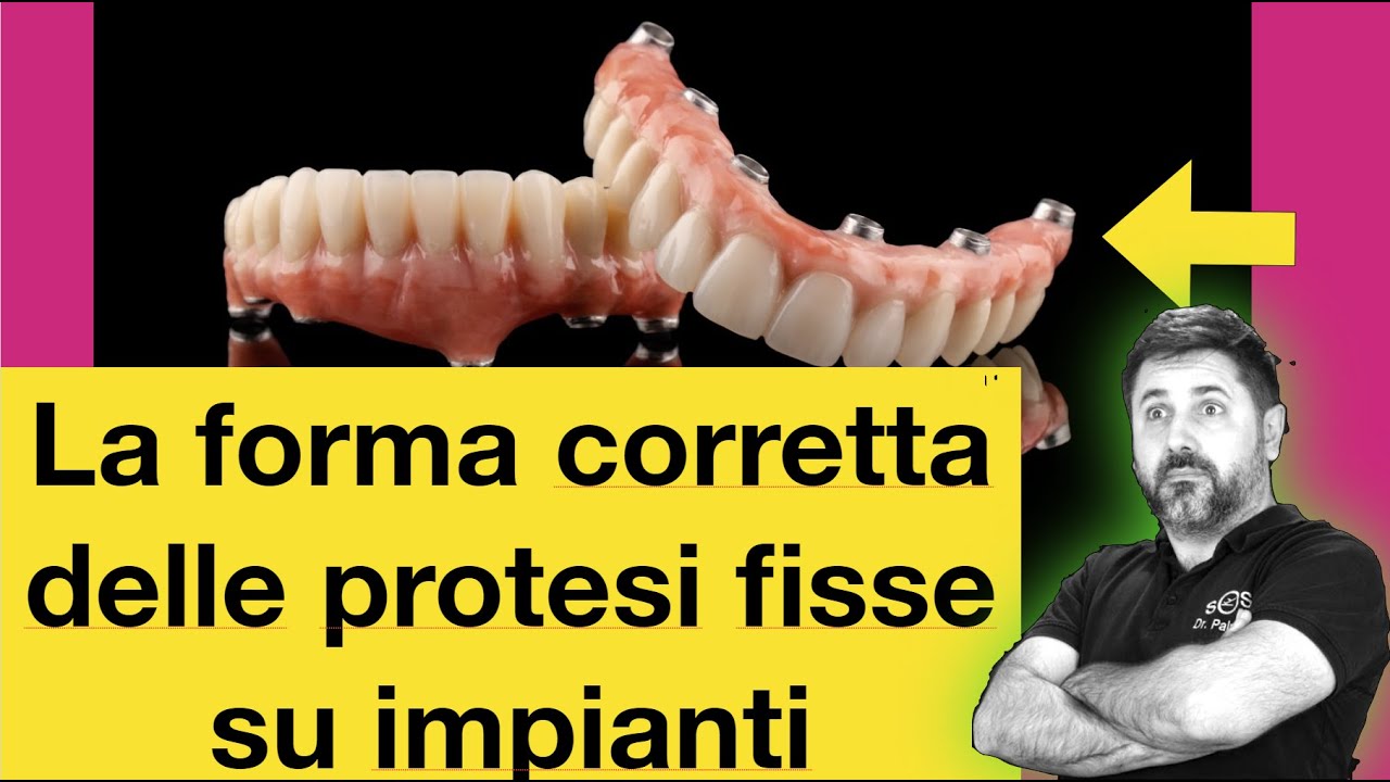 La forma corretta delle protesi fisse su impianti dentali.
