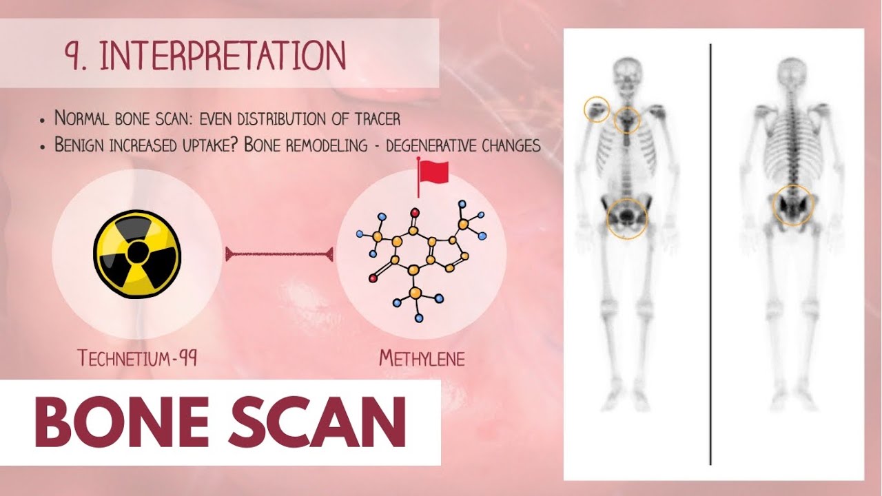 Bone Scan Procedure |&nbsp;Dr. Paulien Moyaert