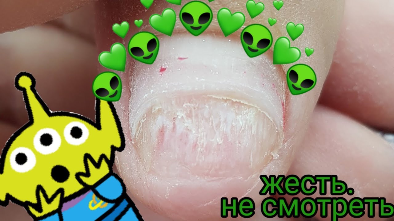 Онихолизис - часть 4, продолжаем приростать/Лечим травмированный ноготок/Шулунова Дарья