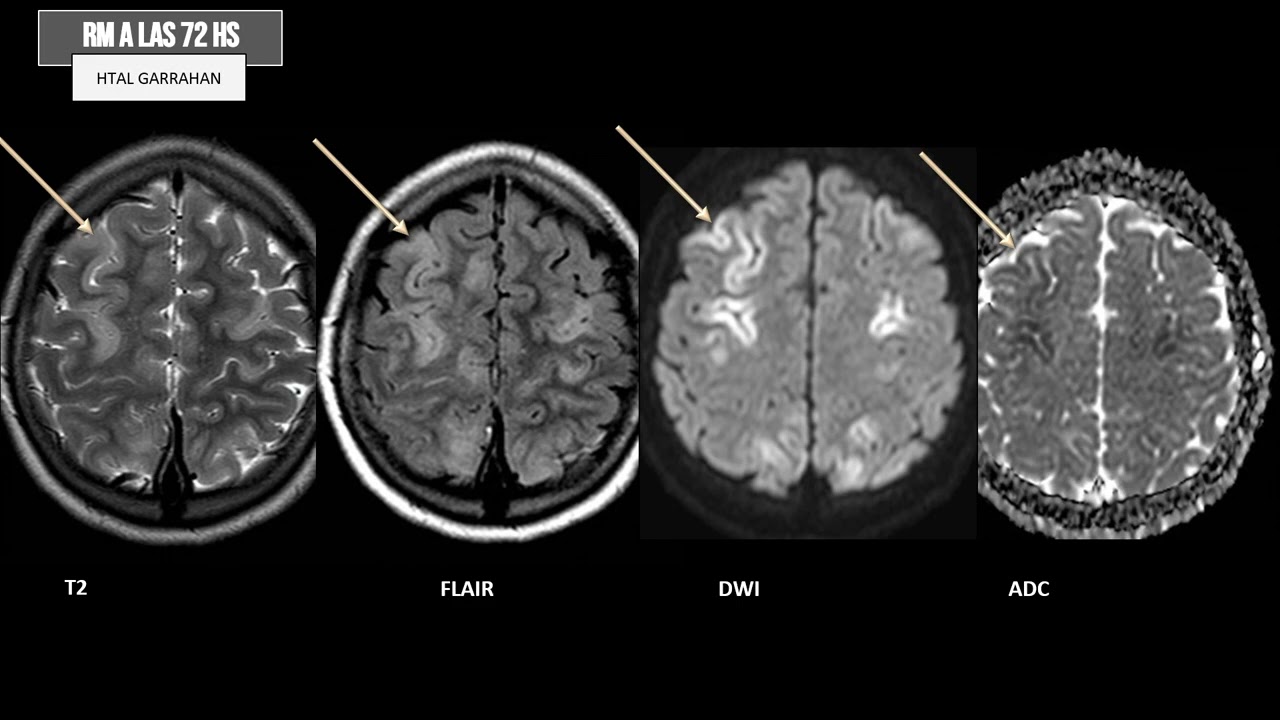 Caso del Mes n°173 Mayo 2024, “Embolia gaseosa cerebral por laceración vaginal”