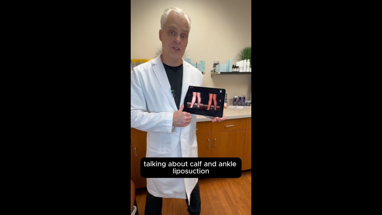 Calf & Ankle Liposuction Before & After | 20+ Years of Dr. Wright&rsquo;s Expertise