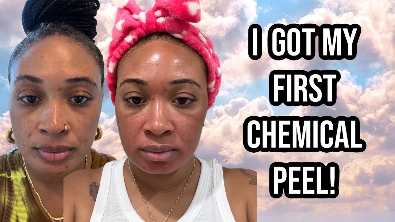 COME WITH ME TO GET A COSMELAN PEEL PT. 1