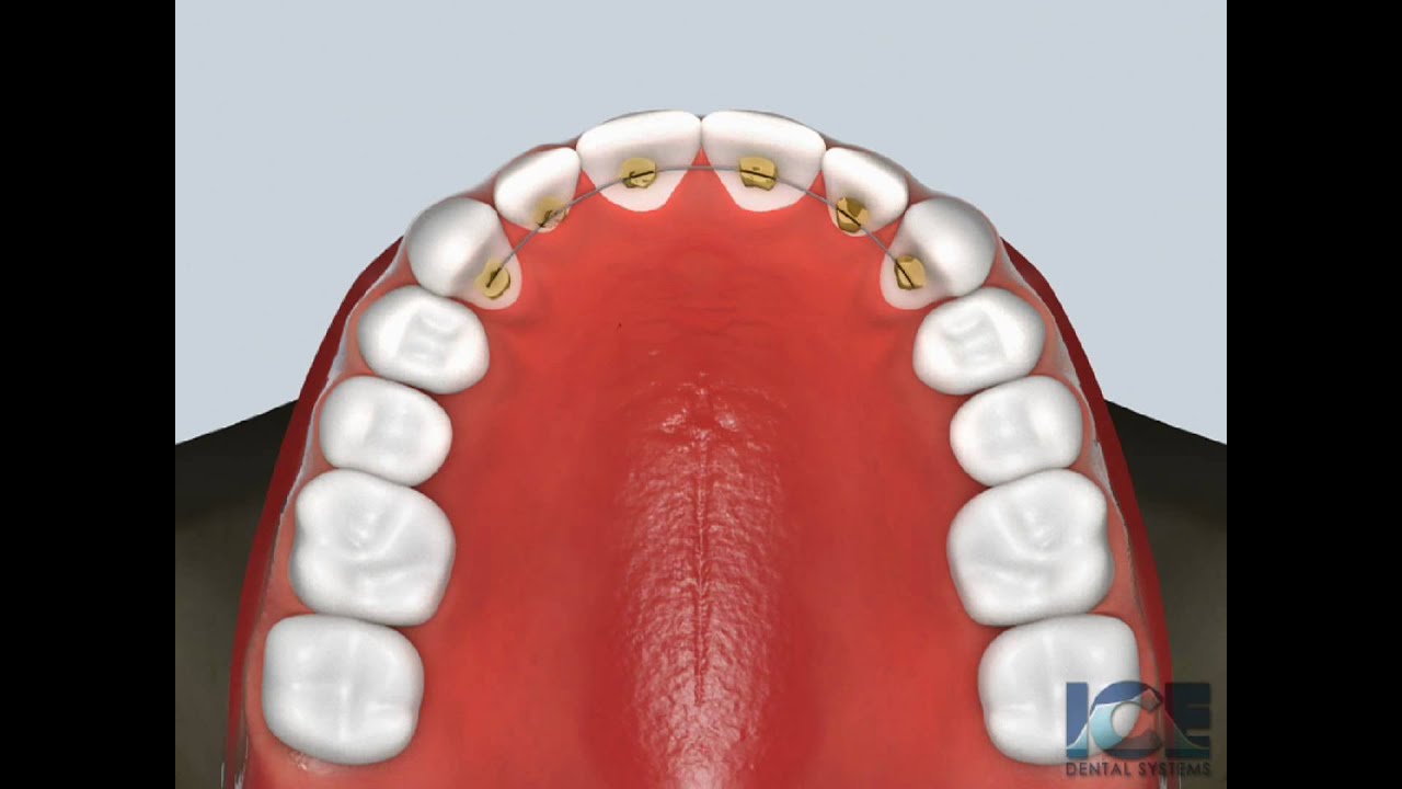 Bonded Retainer (Upper)