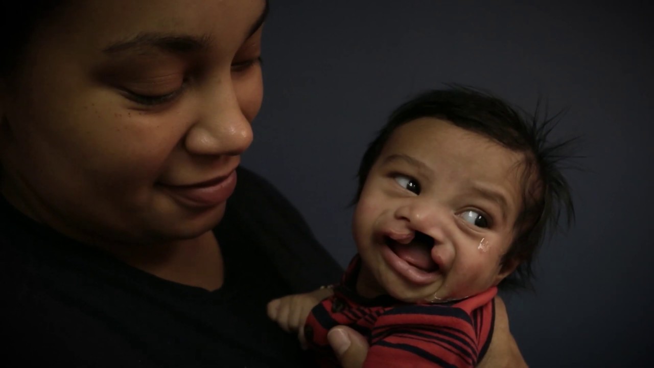 Breastfeeding A Cleft Lip and/or Palate Baby