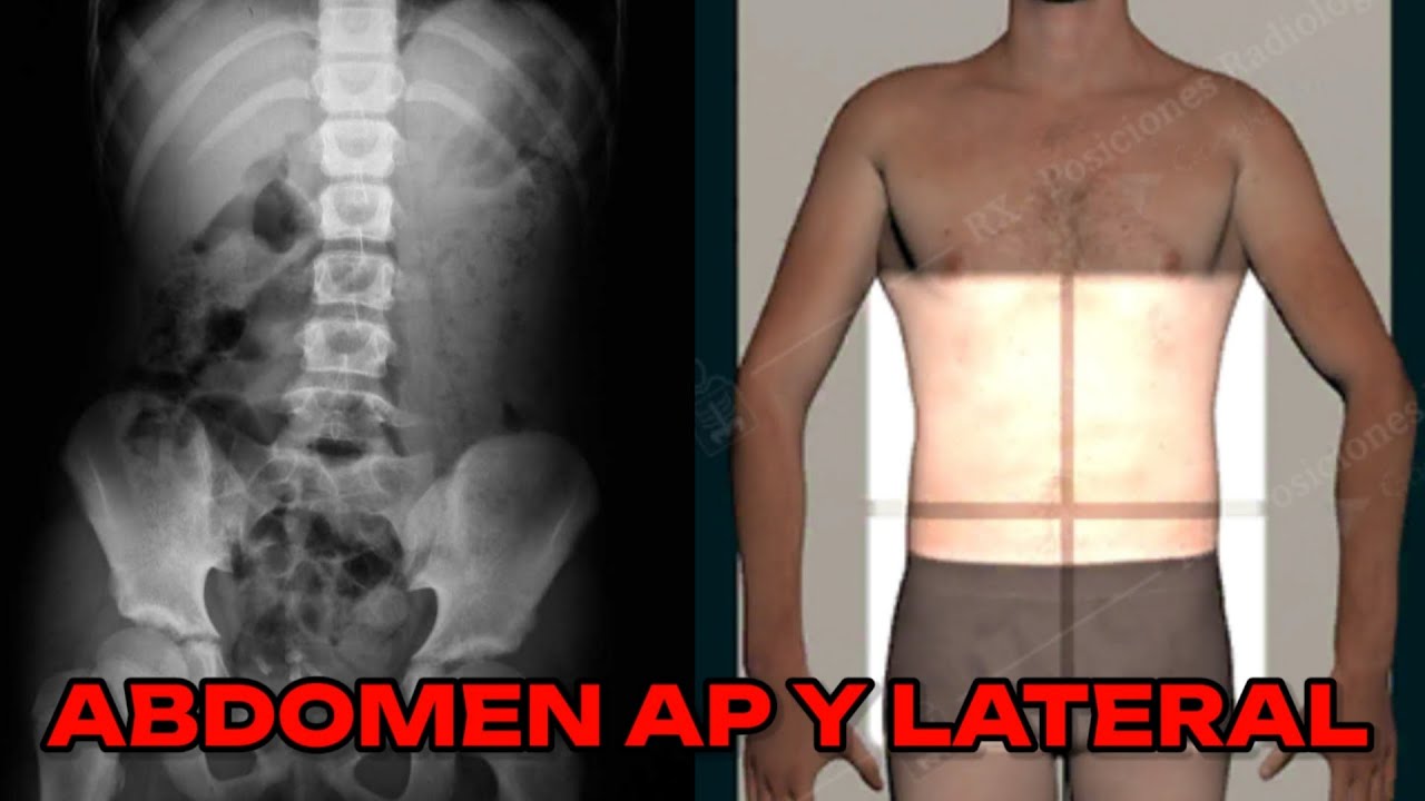 RADIOGRAFÍA DE ABDOMEN AP Y LATERAL (MANUAL DE BOLSILLO) #14