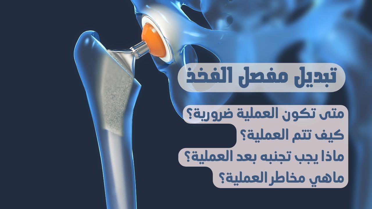 كل ماتحتاج معرفته عن تبديل مفصل الفخذ