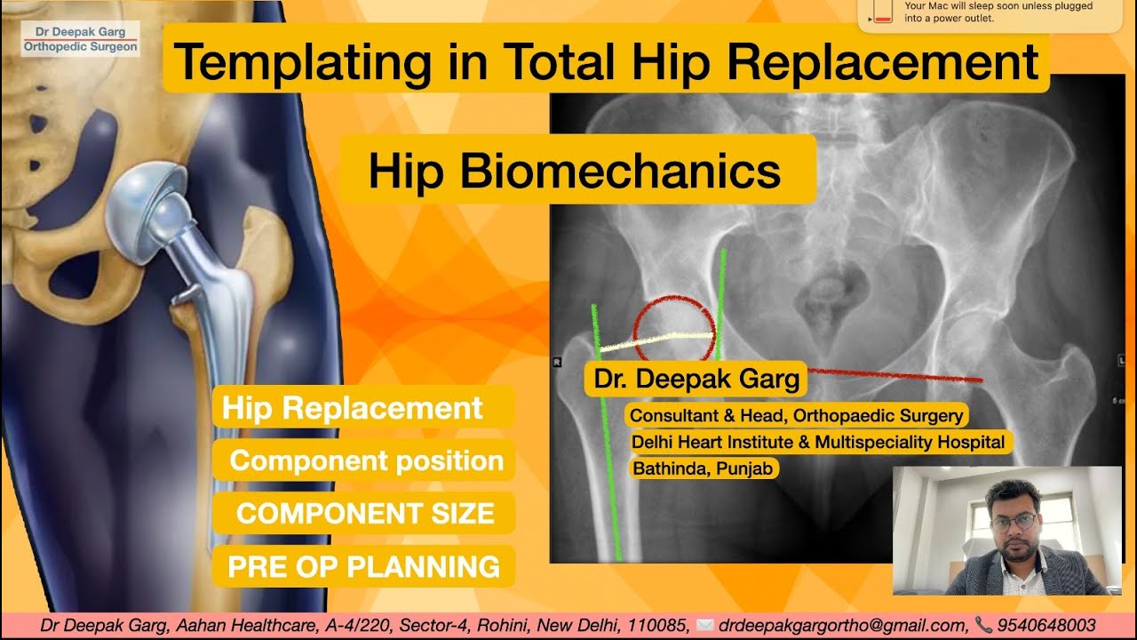 Dr Deepak Garg Shares The BEST PRE OPERATIVE TEMPLATING Techniques