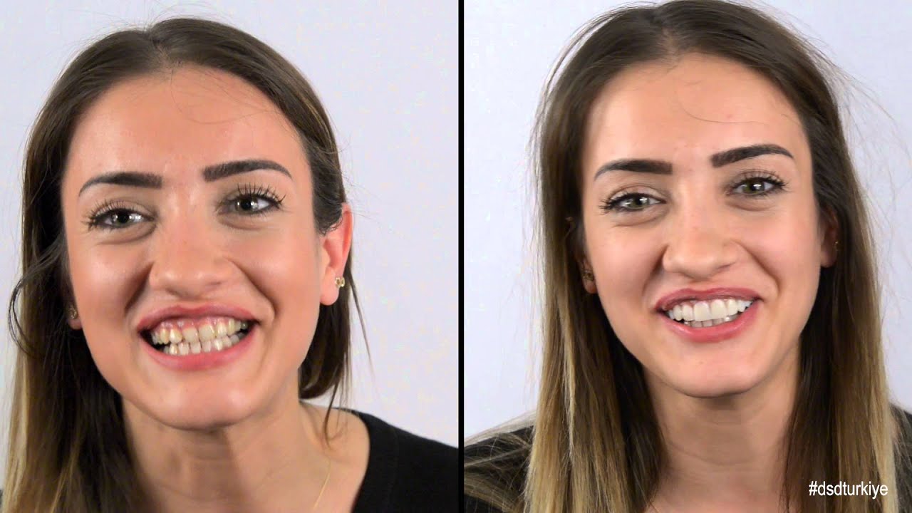 Digital Smile Design Kursu - İstanbul