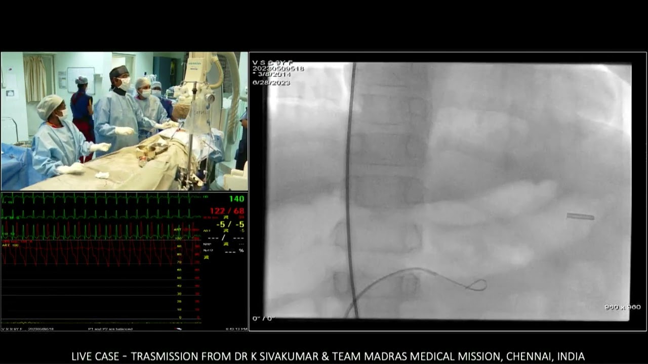 11/12 Sinus venosus atrial septal  defect  closure with covered stent exclusion