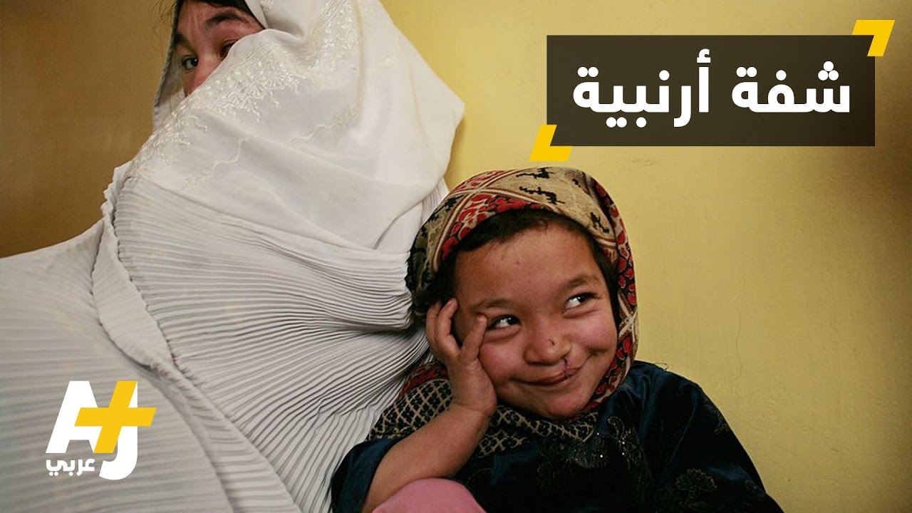 عمليات جراحية في الأردن للشفة الأرنبية