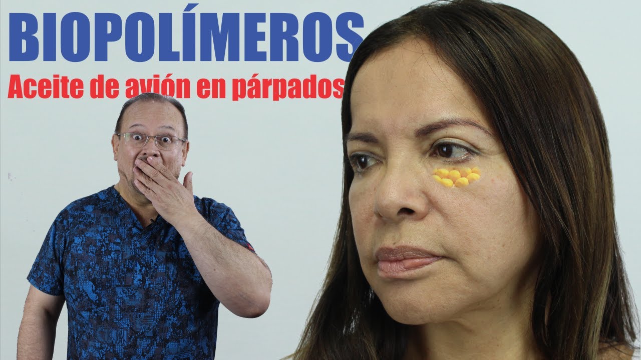 Extracción de BIOPOLÍMEROS 🥵 Aceite de Avión en párpados 💩 Eliminar de la cara 🤩 Dr ALBERTO CALVO