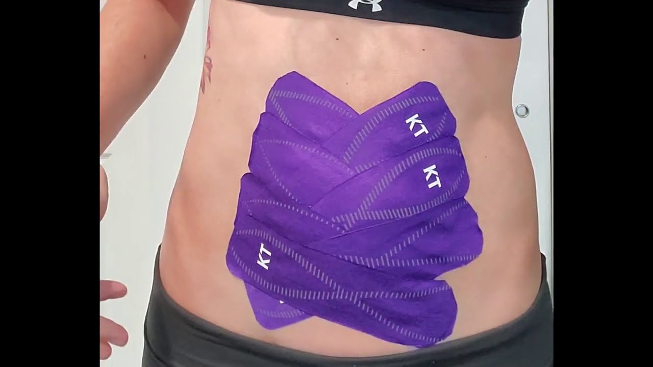 Taping for diastasis recti: criss cross method | Connect PT