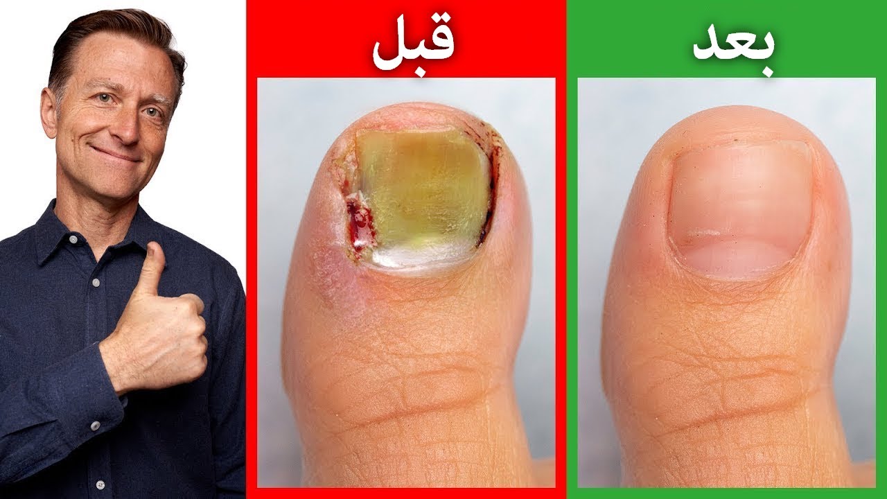 كيفية علاج فطريات أظافر القدم بأقل تكلفة ممكنة