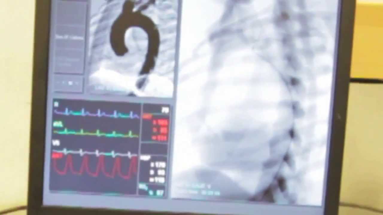Left Common Carotid Artery Catheterisation