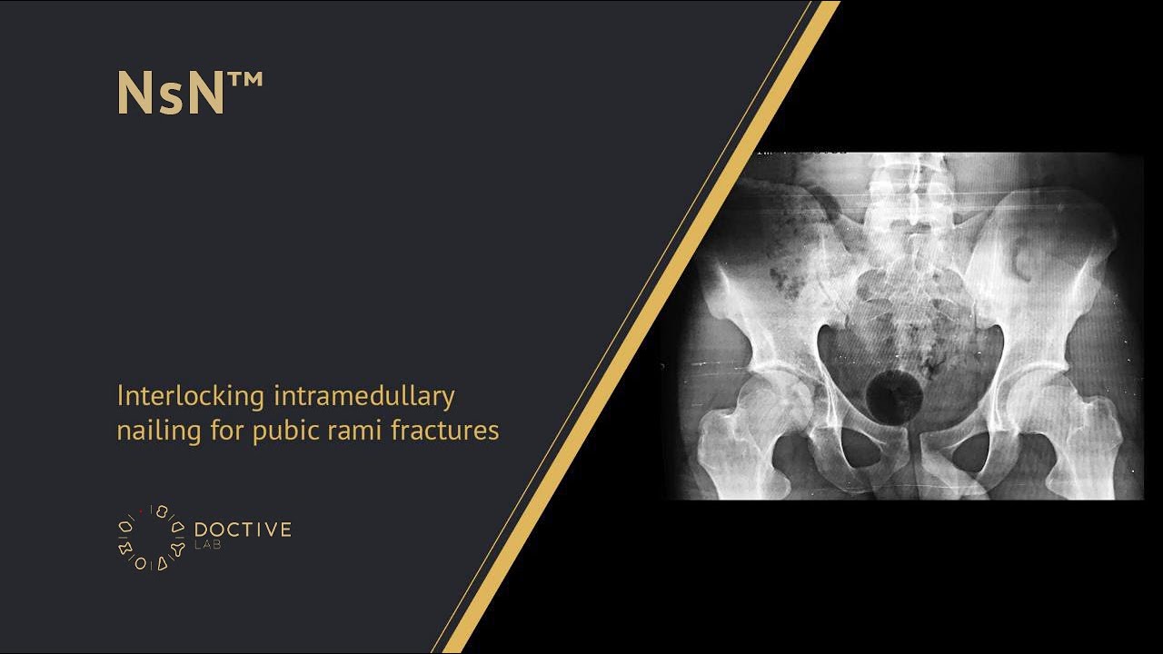 Retrograde locking nail for pubic bone osteosynthesis. Nsn&trade;