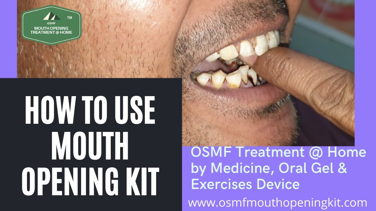 How to Use Award Winning OSMF Mouth Opening Kit Medicine, Exercises Device treatment @ Home in Hindi