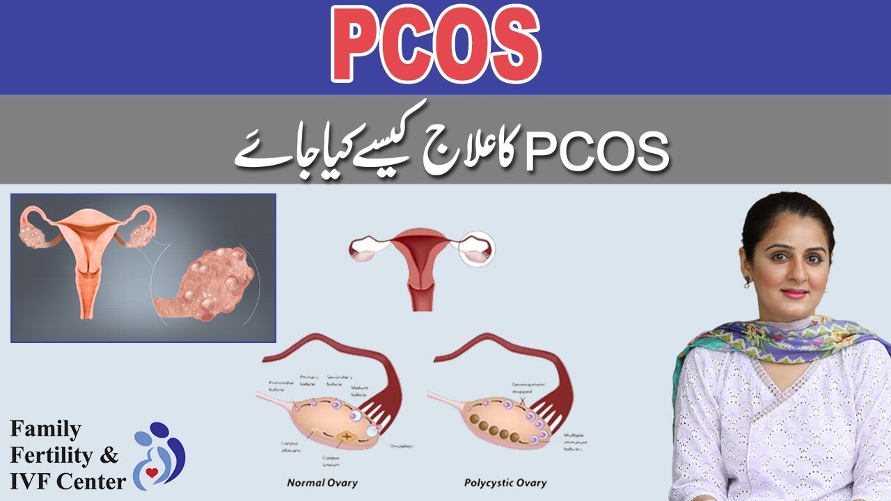 How to treat PCOS in Urdu/Hindi - Dr. Sophia Umair Bajwa - Family Fertility & IVF Center, Lahore