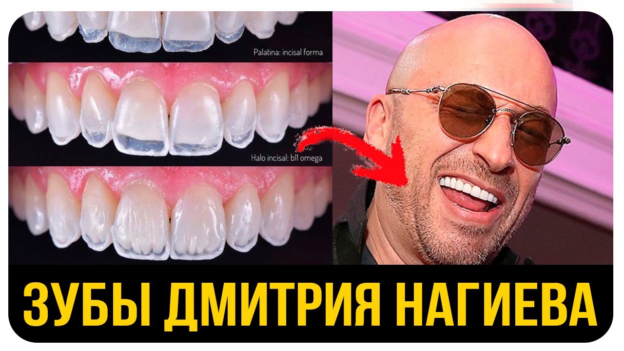 Дмитрий Нагиев. До и После. Кривые Зубы Знаменитостей. Сколько Стоят Элайнеры или Виниры?