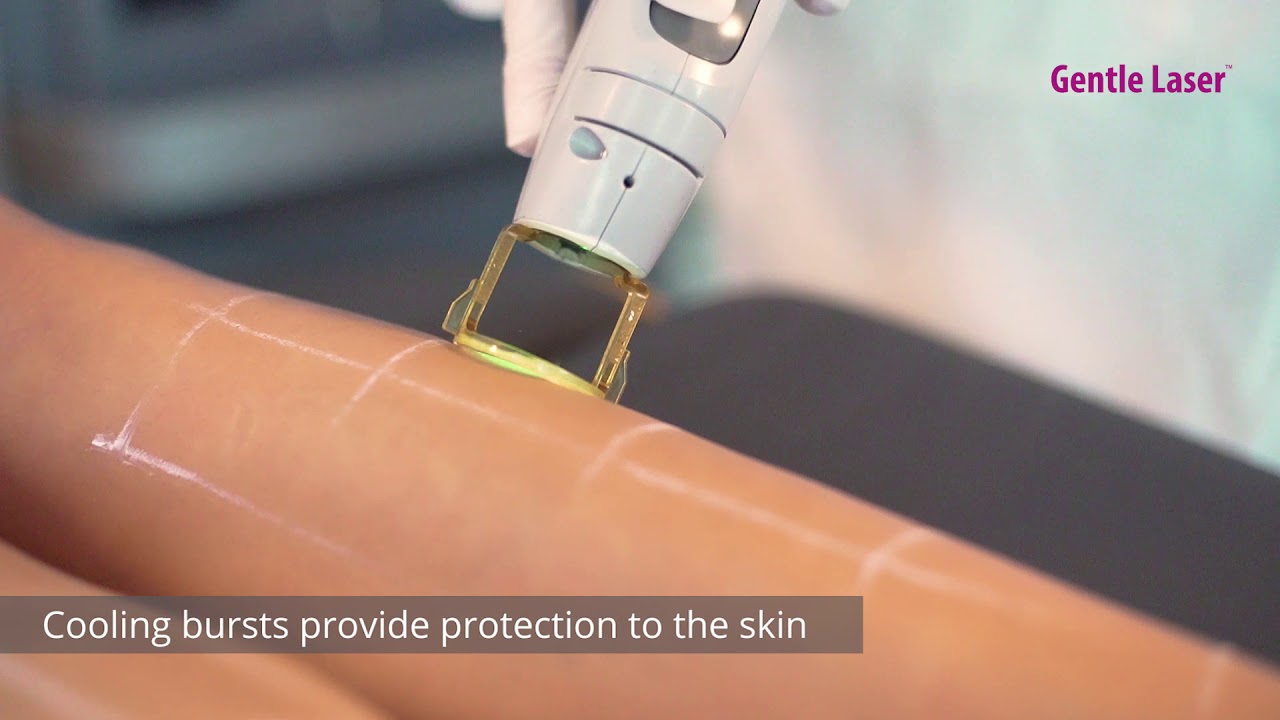 Laser Hair Removal - Candela GentleMax Pro