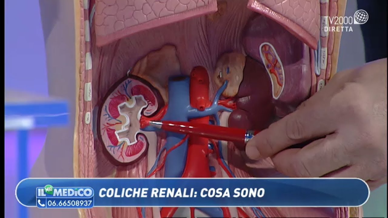 Il Mio Medico - Coliche renali: cosa sono