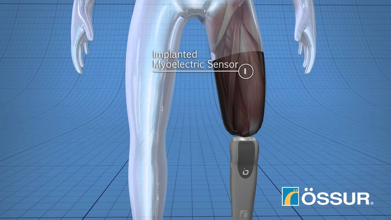 Ossur Bionic Leg