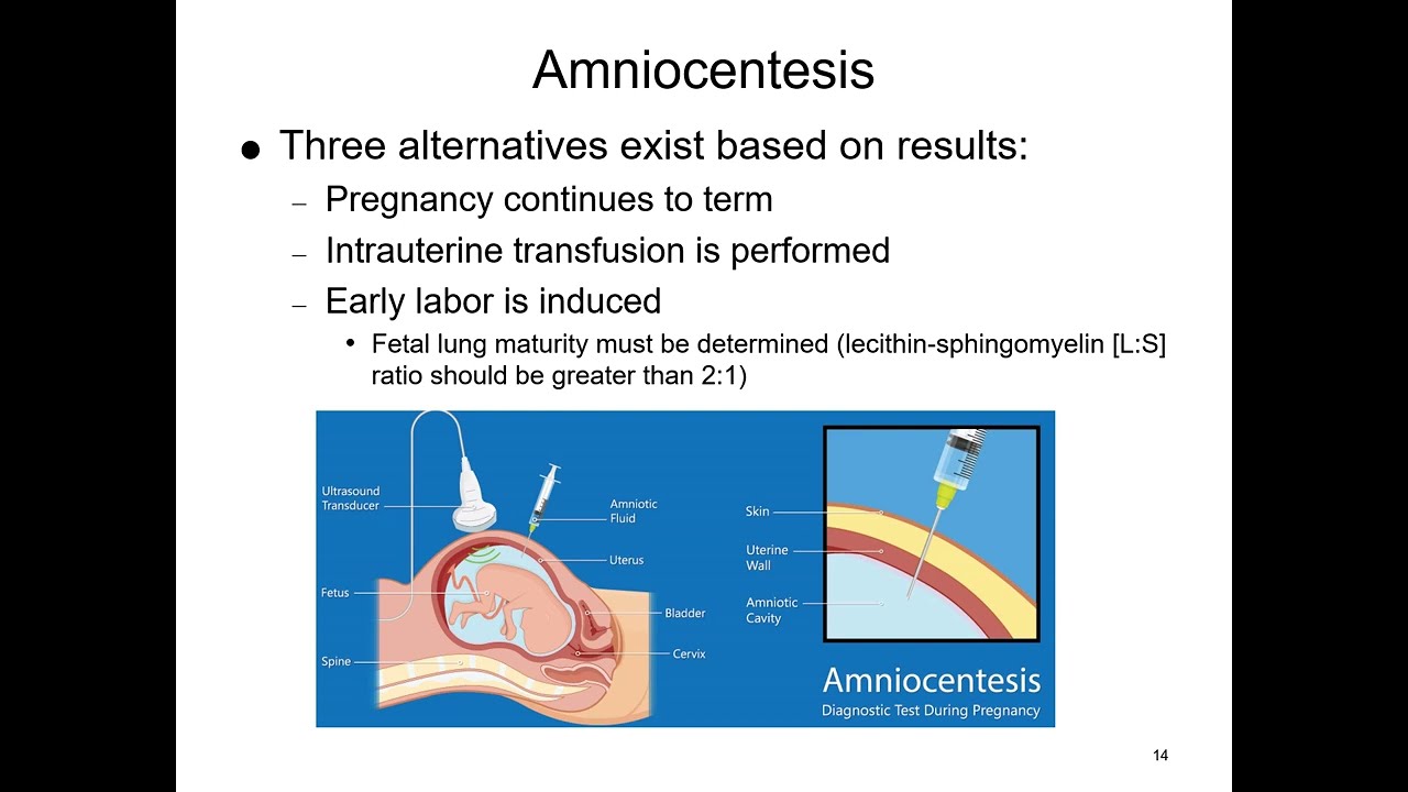Hemolytic Disease of the Fetus and Newborn