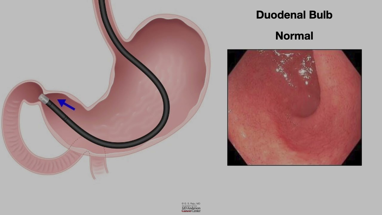 2025 ASGE Endoscopy Tech Course  - C - Small Intestine