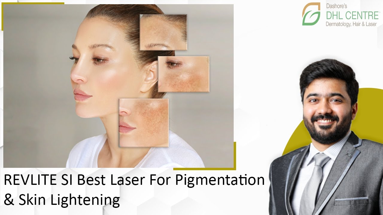 REVLITE SI Best Laser For Pigmentation & Skin Lightening | Improve Your Skin Tone At DHL Skin Centre