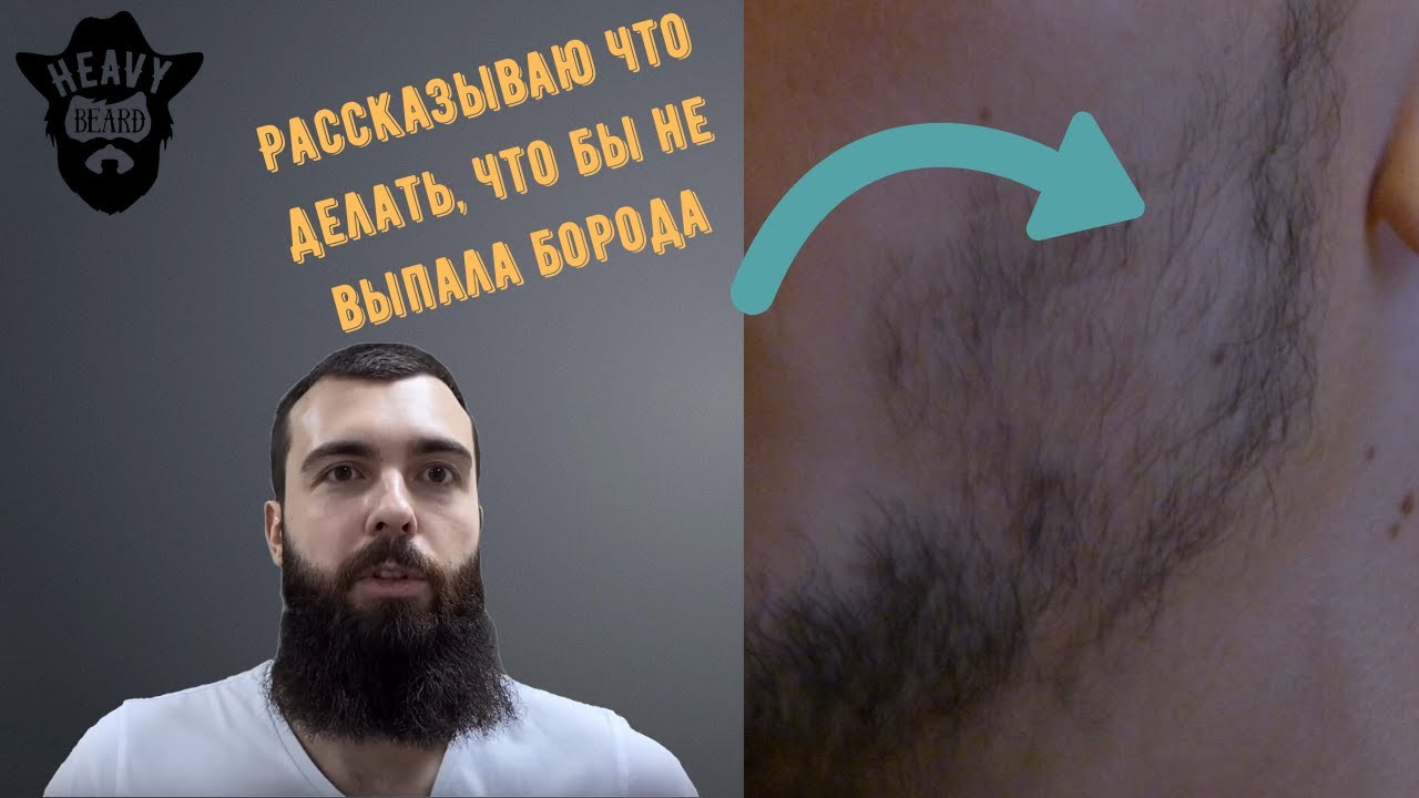Что происходит с бородой после отмены миноксидила