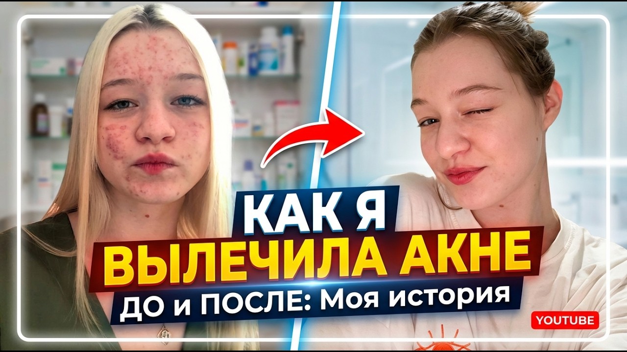 Как я избавилась от акне? (а избавилась ли?) 🤔