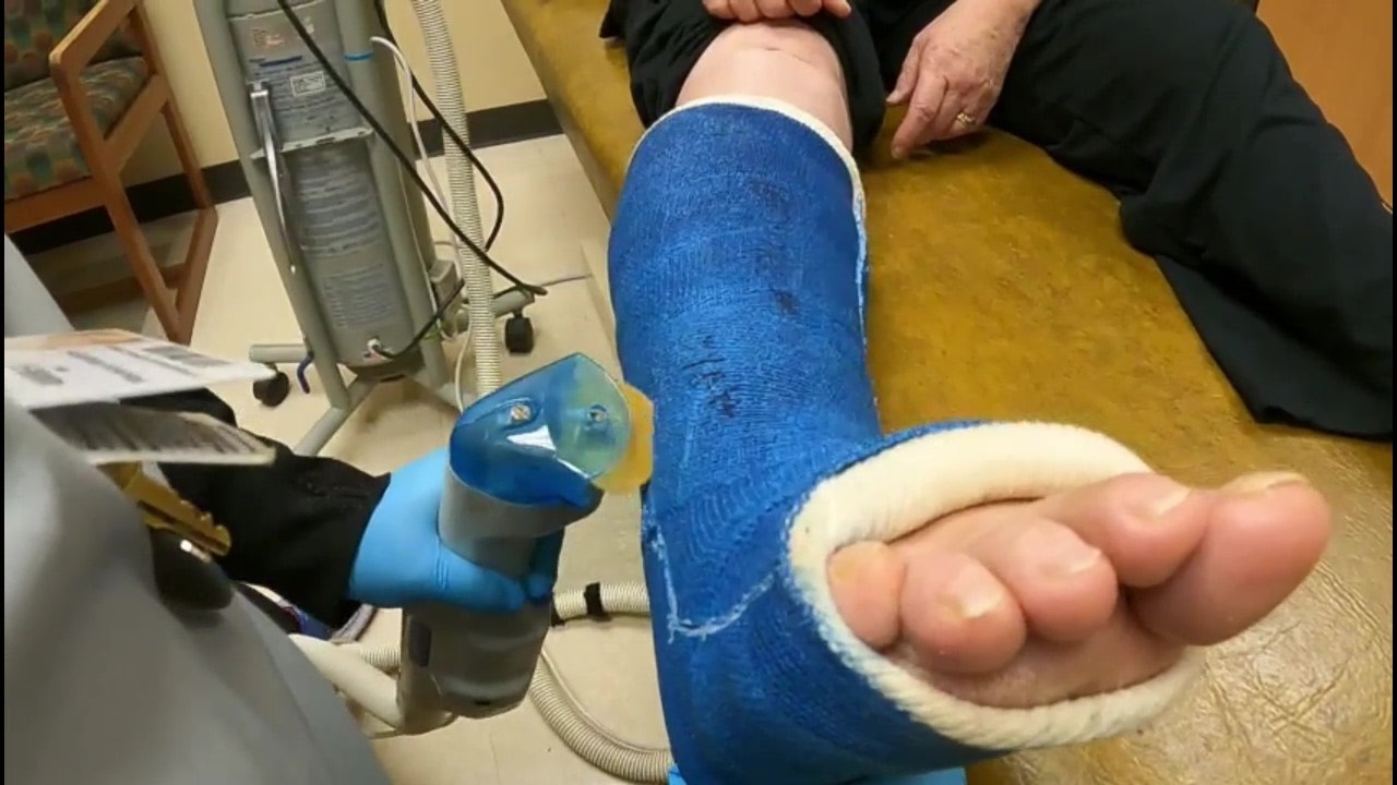 Cutting the Cast Off My Wife's Leg...Interesting.