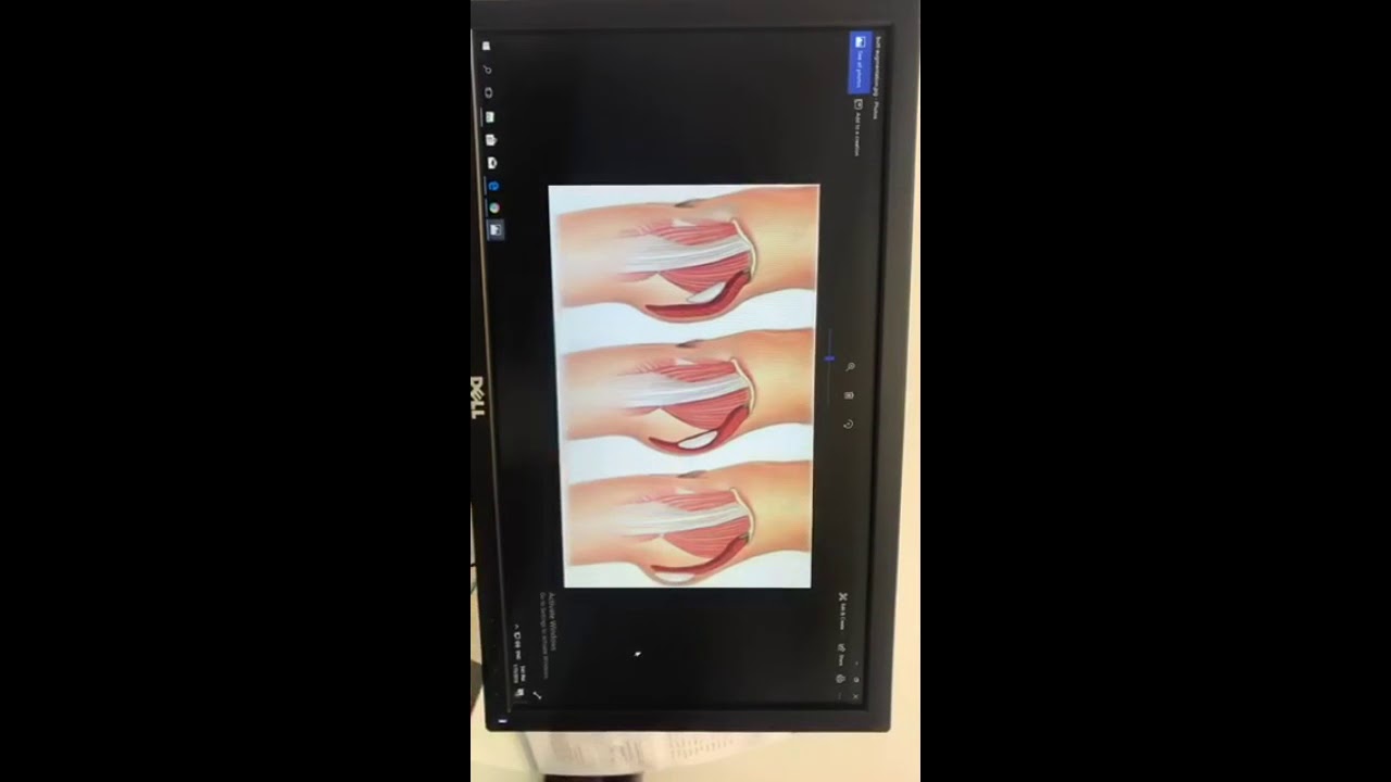 تكبير المؤخرة بحشوات السيلكون و أنواع الحشوات