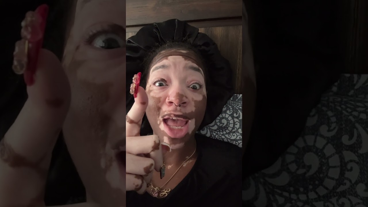 Объясните мне это 🤬😭 | #витилиго #исследуйте #шорты #ленташорт